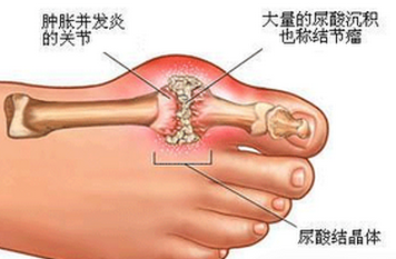 最新痛风治疗方法